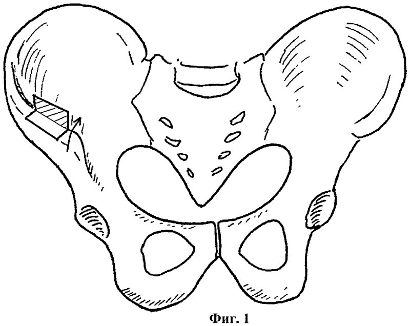 Гребни тазовых костей